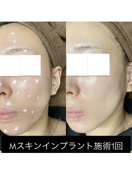 ウエビリア 川越店/白いクリームの中に針100万本!