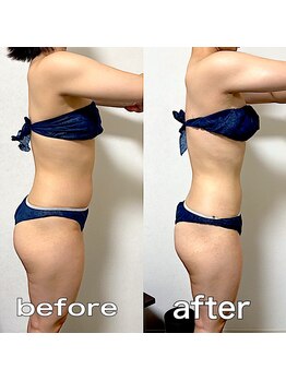 エステサロンクオーツ/１ヶ月の変化♪