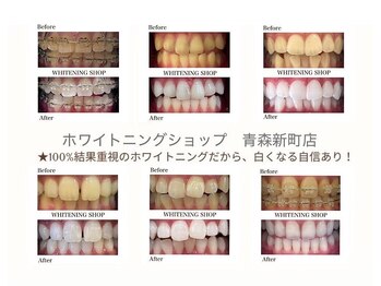 ホワイトニングショップ あおもり新町店/輝く歯 印象up Before After