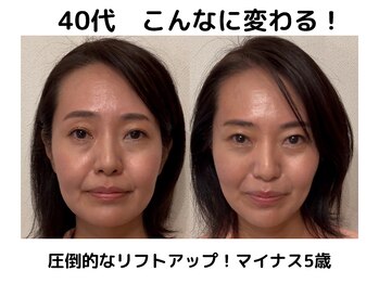 エンジェルエッグ/◆40代女性　圧倒的リフトアップ