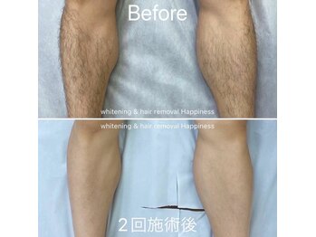ハピネス 広島並木通り店(Happiness)/両脚脱毛Before→After