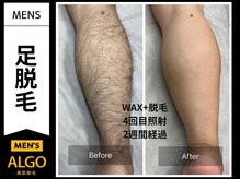 アルゴ 山口宇部店(ALGO)/脱毛初めて！4回目でこの効果！
