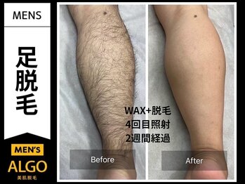 アルゴ 山口宇部店(ALGO)/脱毛初めて！4回目でこの効果！