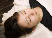 アキュレ(Acure)/★アキュレ式美容鍼★