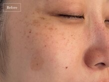 キュレイテッドスキン(CURATED SKIN)/水光/白玉/プラズマ/レモン/毛穴