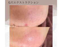 ベルーテ 田町三田(Bellute)/あごのプツプツにも効果的★