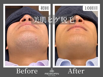メンズスタジオ リボーン(REBORN)/顔脱毛/ひげ脱毛/松山