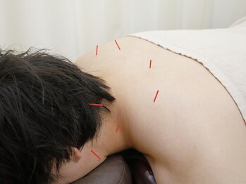 鍼灸整骨院ちとせ/鍼灸施術