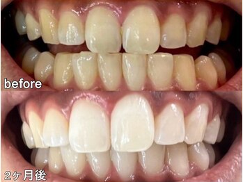 グラーティア 梅田店(gratia)/ホワイトニング★2ヶ月目★