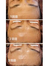 シャンディ(Shandy)/ラミピールで肌管理