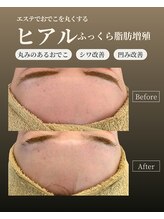 オーラ(AURA)/まん丸なおでこが叶う！