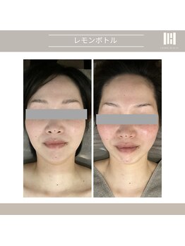 カリスボーテ 関本店/レモンボトル