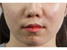 モアサロン(MOA salon)/ララピール2回目