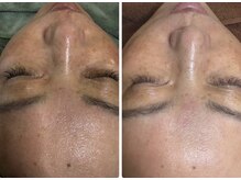 グリッター(GLITTER)/肌変化