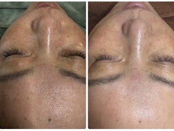 グリッター(GLITTER)/肌変化