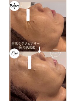 グラサヴォーグ 金沢店/限定コース雪肌ラグジュアリー