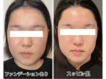 アルバ 広島店(ALBA)/【肌質改善☆】水光ピーリング