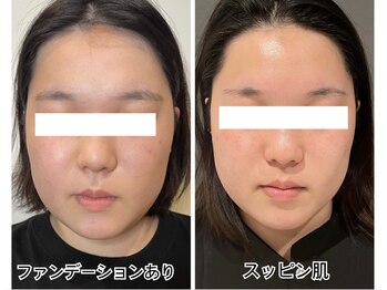 アルバ 広島店(ALBA)/【肌質改善☆】水光ピーリング