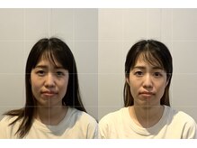 小顔矯正整体サロン イクサス(IxAS)/初回での<before&after>
