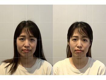 小顔矯正整体サロン イクサス(IxAS)/初回での<before&after>