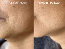 サロン ド エン(Salon de. en)/たるみケア◇ハーブピーリング