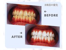 スマイルホワイト 練馬店/ホワイトニングビフォーアフター