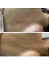 カヌヌ(Kanunu)/1回の照射でもこの違い！