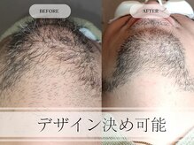 メンズプラス(MEN’S PLUS)/ヒゲ脱毛