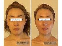 パル コルギサロン(Pal. Korugi salon)/コルギビフォーアフター