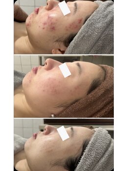 エラン(ELAN)/ニキビ肌質改善【Dr,sハーブ】