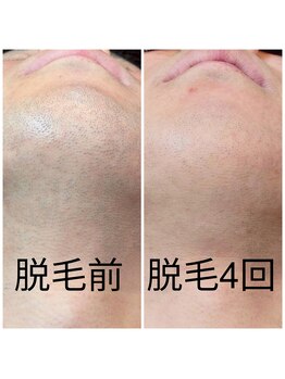 エミナル(EMINAL)/~ヒゲ脱毛の効果~脱毛/髭脱毛