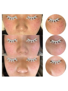 ナンバーナイン(No.9)/ピグメンテーションデトックス