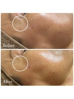 エース(ACE.)/小じわ改善☆ハーブピーリング