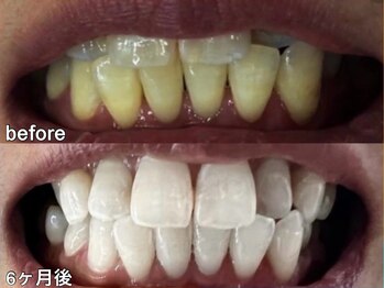 グラーティア 梅田店(gratia)/ホワイトニング★6ヶ月目★