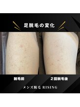 ライジング 熊本菊陽光の森店(RISING)/あし脱毛2回の変化！