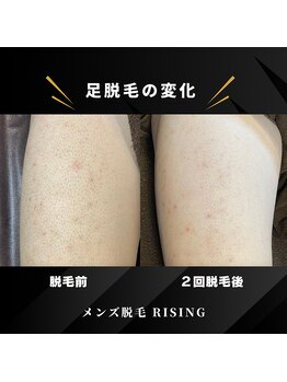ライジング 熊本菊陽光の森店(RISING)/あし脱毛2回の変化!