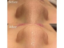 ベラピエル(BELLA Piel)/毛穴洗浄3回