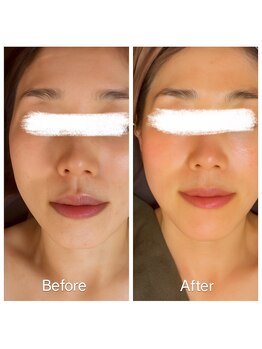 ラビ(RABBI)/40代女性小顔矯正