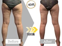 ジャパ(JAPA)/今話題の脂肪冷却☆