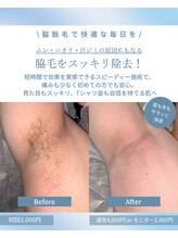 メンズラボ 京都駅前店/脇脱毛ビフォーアフター◎