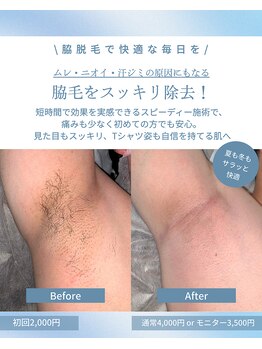 メンズラボ 京都駅前店/脇脱毛ビフォーアフター◎