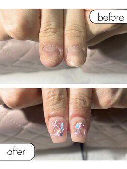 ピノ(pino)/◆深爪矯正＋長さだしアート◆