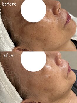 スパ ナナプラス(SPA nana+)/美白ケア◎光フェイシャル