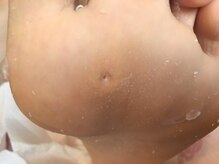 ビサンテ サロン/魚の目・鶏眼に熟練フットケア中