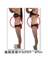 ブラン ネージュ(Blanc Neige)/脂肪冷却