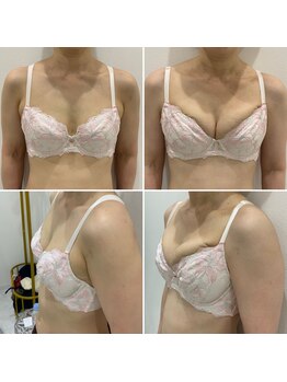 トロイカ(troika)/バストアップ 6回での効果★