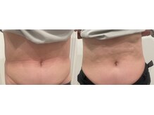 ルナート(Lunart)/腸もみの一回の変化