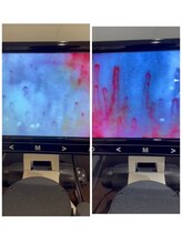 タカイ(TAKAI)/血流検査　名古屋育毛促進　