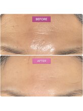 泡のきもち/【うるおいハリ艶ケア】1回目後