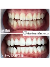 ホワイトニングサロン 京都烏丸店/ホワイトニング施術例